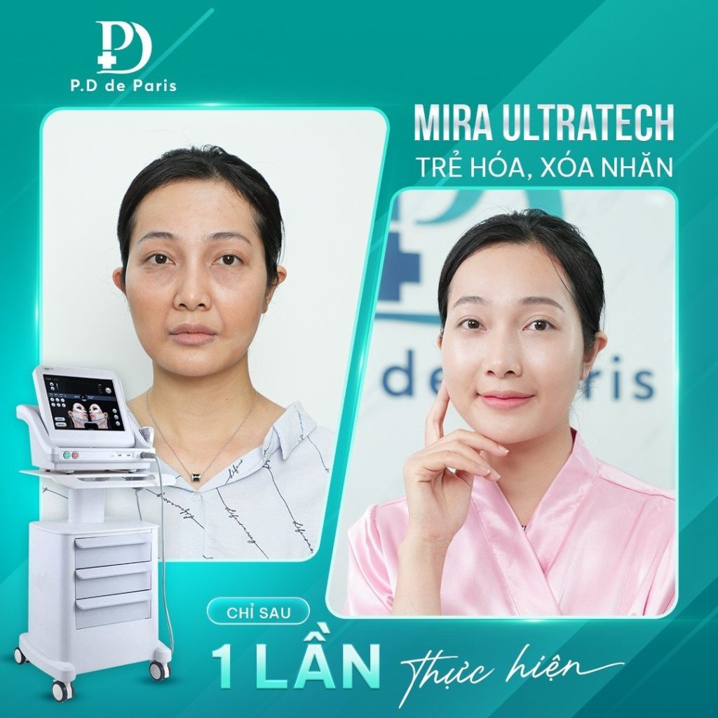 Công nghệ Mira Ultratech để làm đầy và nâng cao gò má