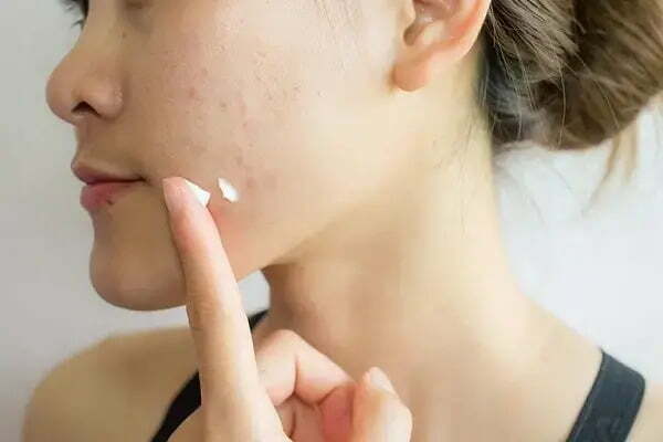 Tretinoin cho hiệu quả trong việc trị sẹo rỗ sau khoảng 2-3 tuần sử dụng