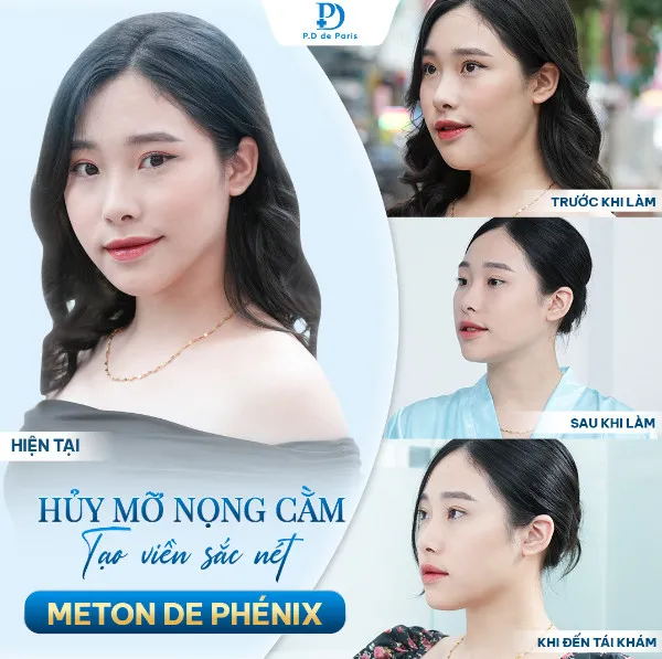 Hủy mỡ nọng cằm, tạo viền hàm sắc nét với công nghệ Meton de Phénix độc quyền tại P.D de Paris