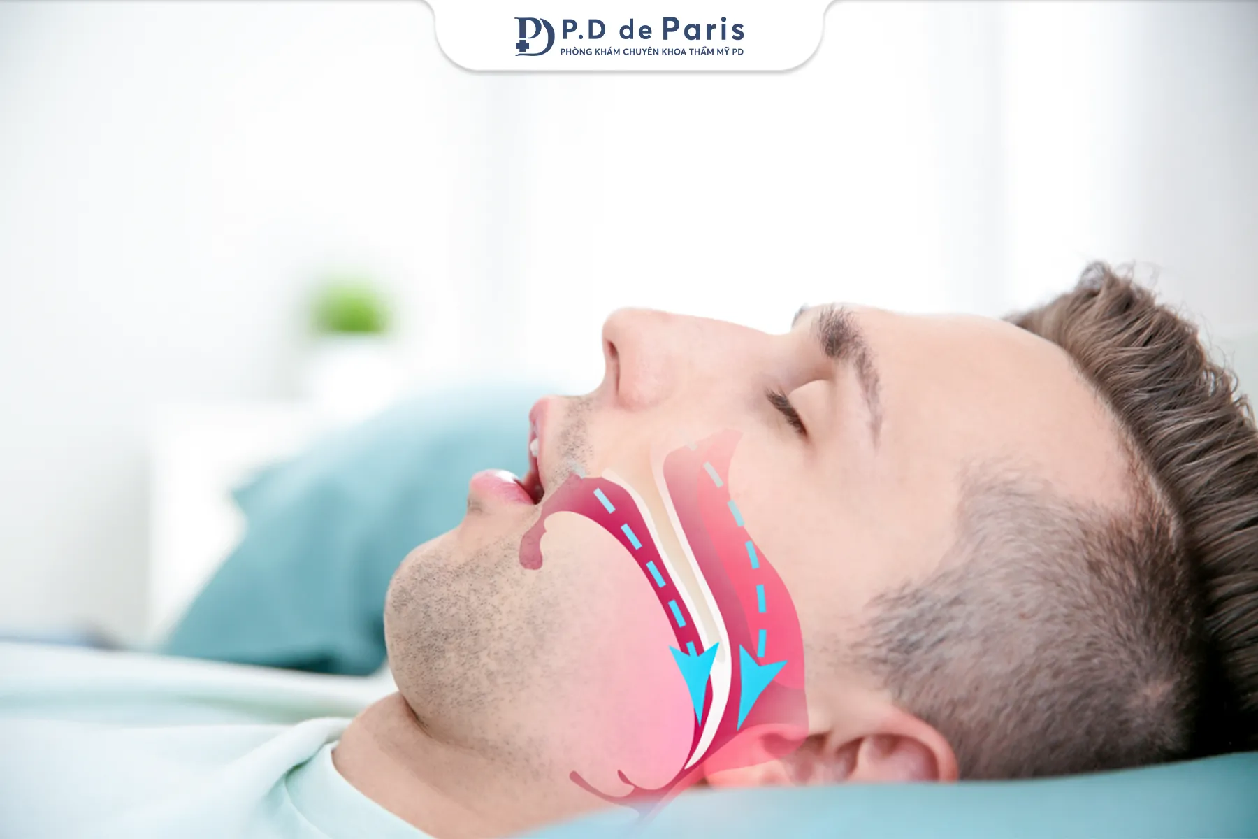 Điều trị ngủ ngáy dứt điểm bằng công nghệ Ultra RF Snoring tại phòng khám P.D de Paris