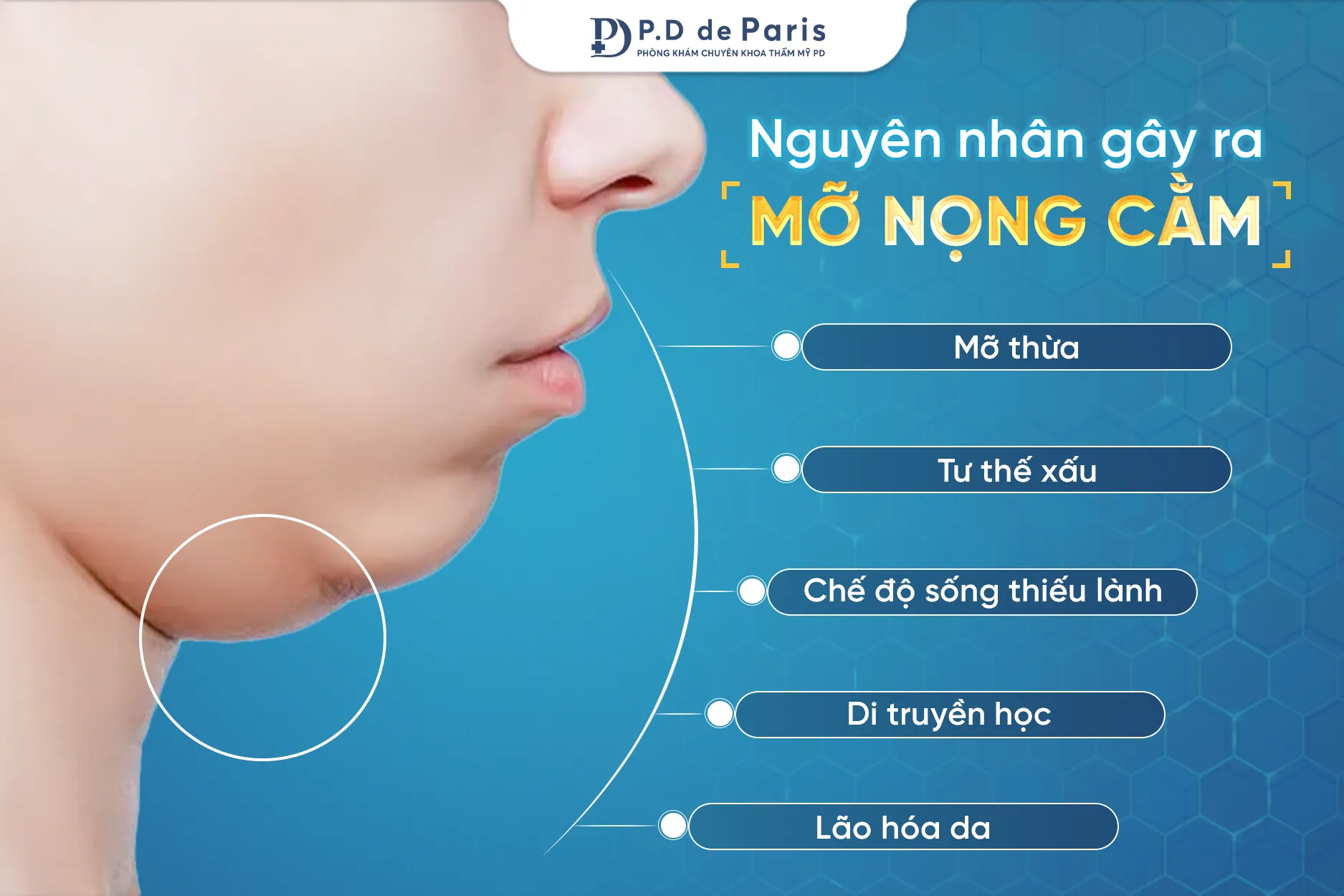 Nguyên nhân gây ra mỡ nọng cằm