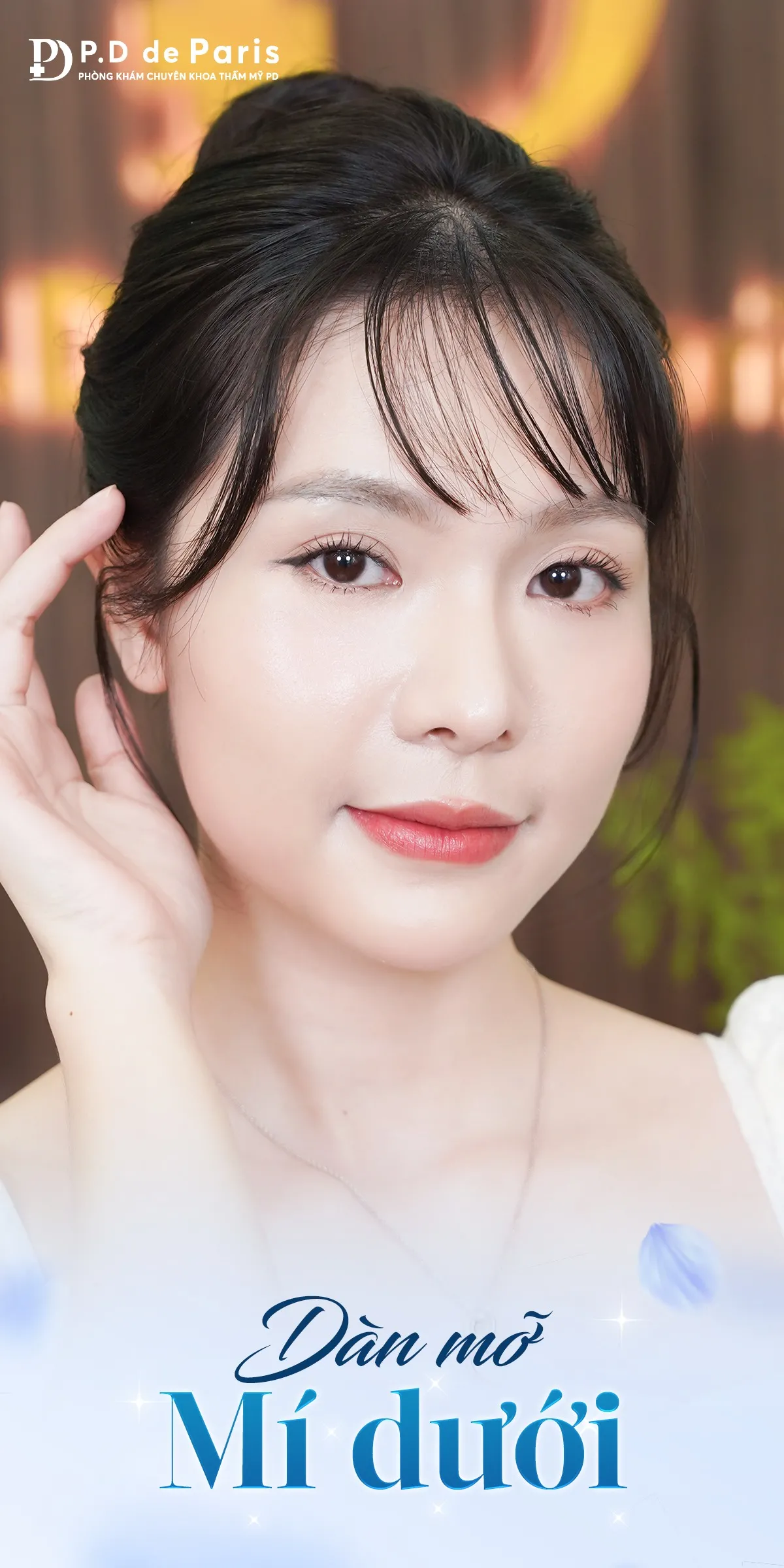 Dàn mỡ mí dưới có làm mắt to hơn không? Có cần kết hợp nhấn mí hay cắt mí không?