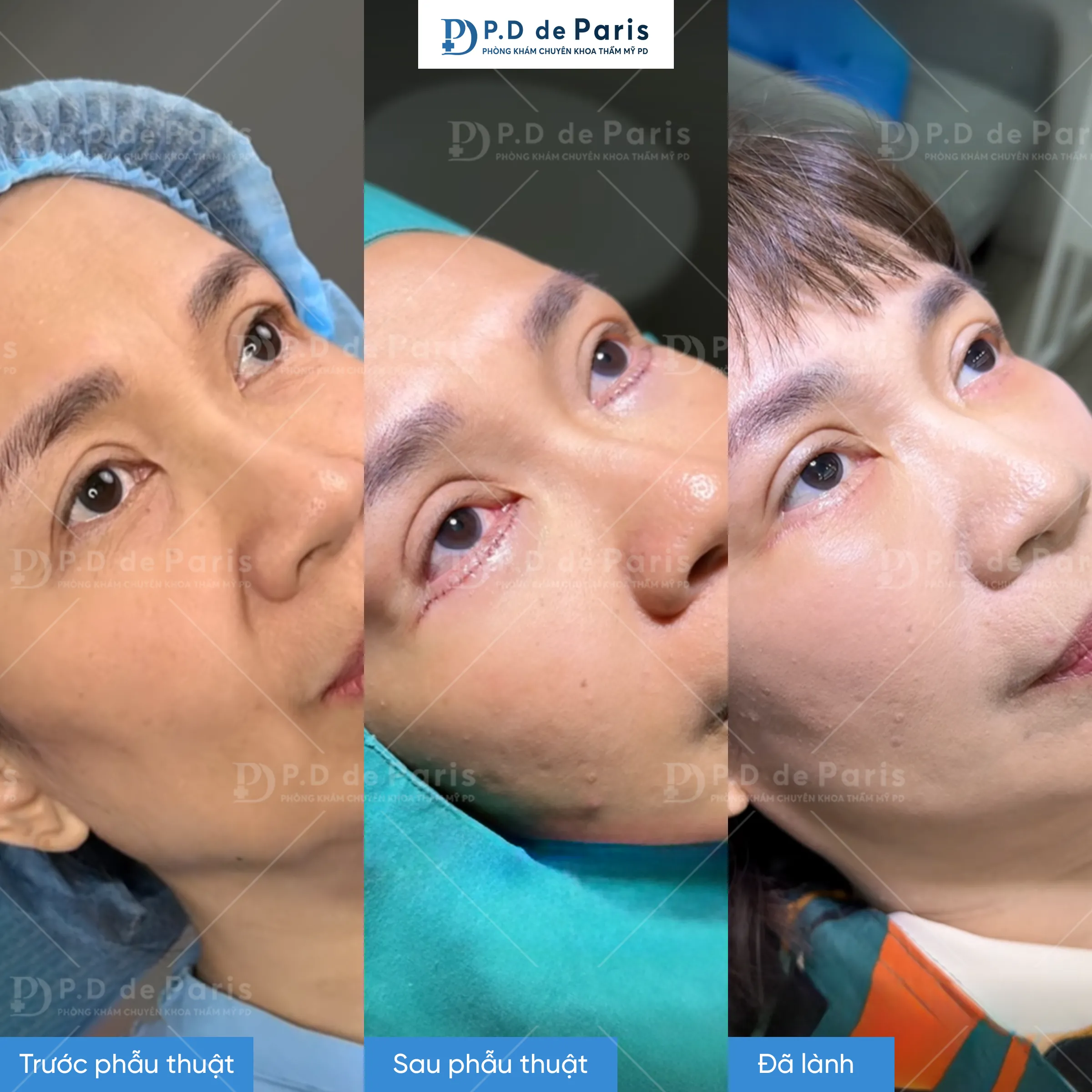 5 dấu hiệu ca dàn mỡ mí dưới bị hỏng và cách phòng tránh