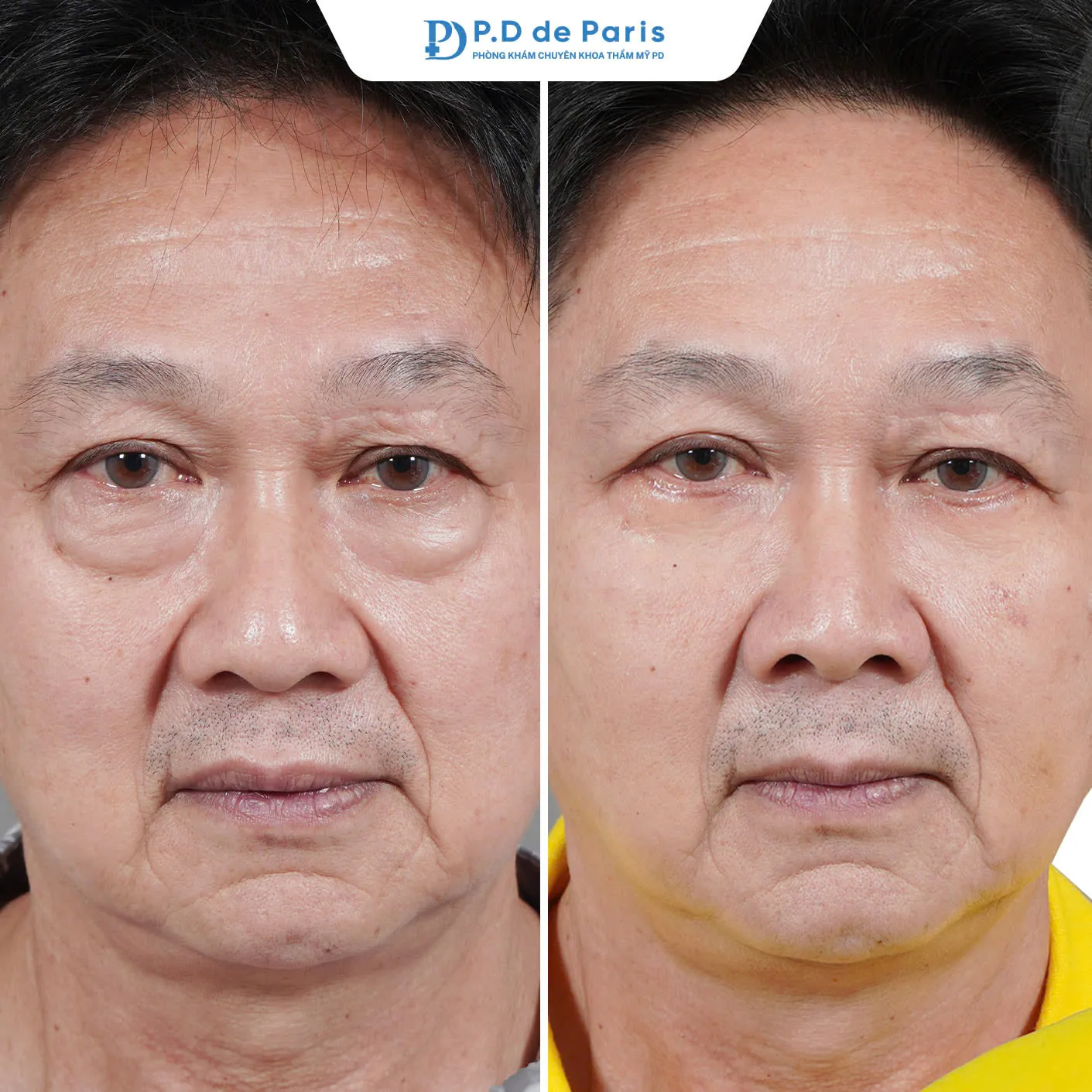 Dàn Mỡ Mí Dưới Là Gì? Khác Gì So Với Cắt Mí Dưới Truyền Thống? Chuyên Gia PD de Paris Giải Đáp!