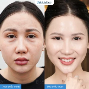 So sánh dàn mỡ mí dưới và tiêm filler: Nên chọn phương pháp nào cho bọng mắt?