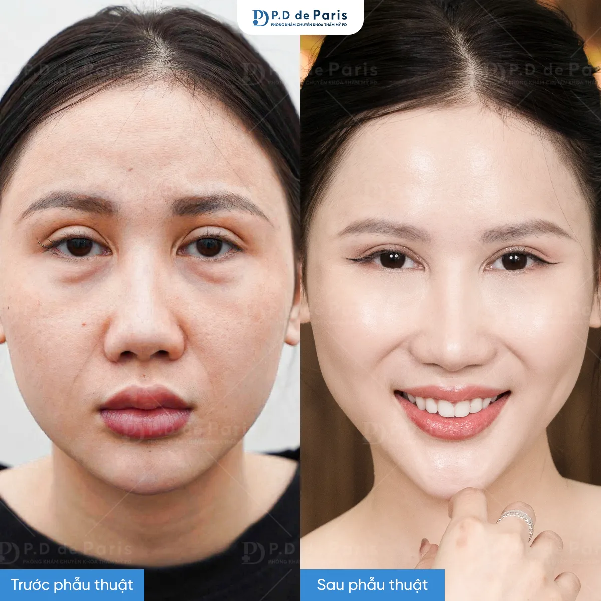 So sánh dàn mỡ mí dưới và tiêm filler: Nên chọn phương pháp nào cho bọng mắt?
