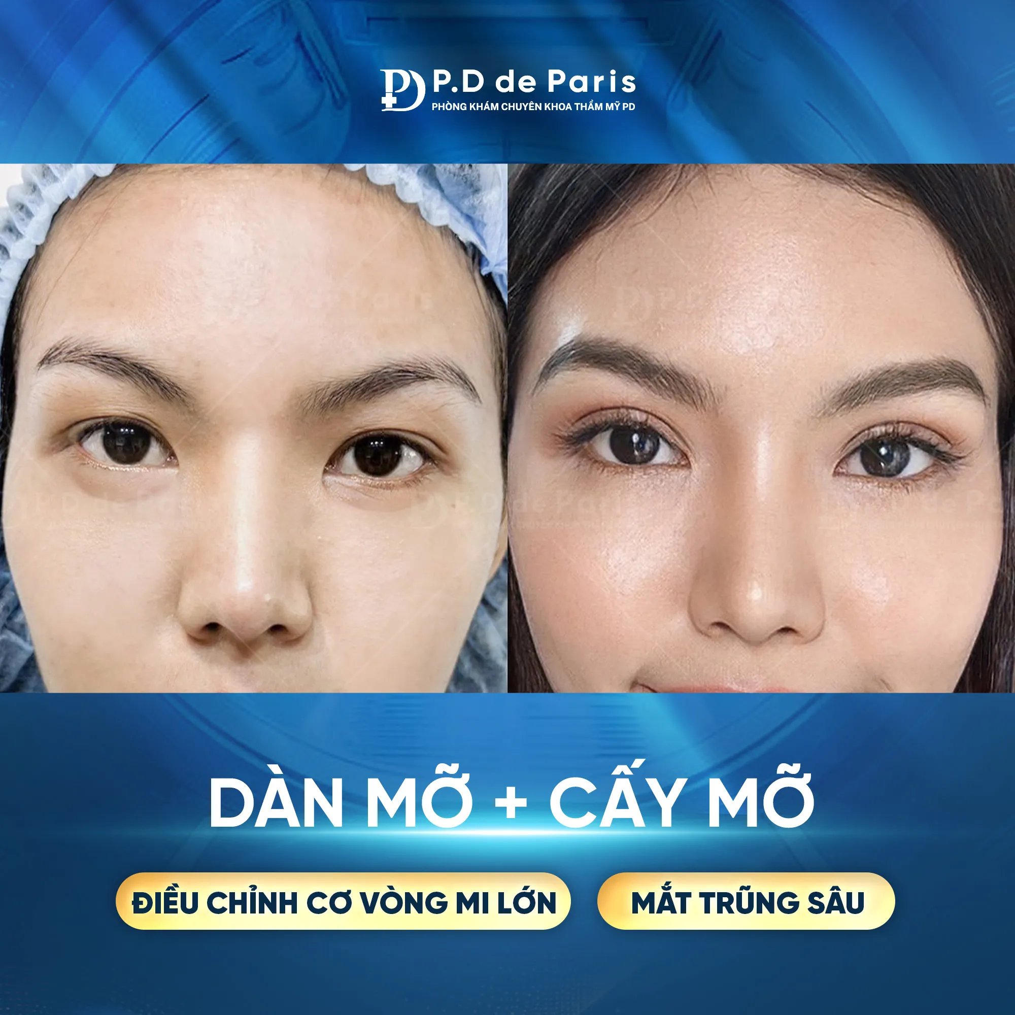 Dàn Mỡ Mí Dưới Là Gì? Khác Gì So Với Cắt Mí Dưới Truyền Thống? Chuyên Gia PD de Paris Giải Đáp!