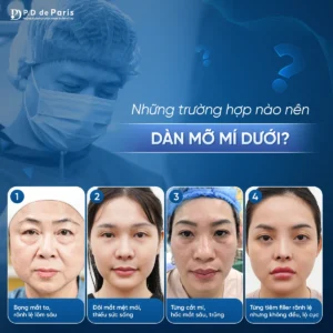 Dàn mỡ mí dưới là gì? Quy trình và công nghệ độc quyền tại P.D De Paris