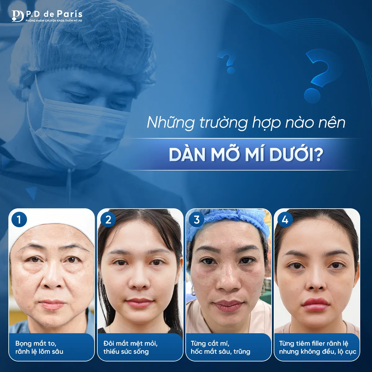 Dàn mỡ mí dưới là gì? Quy trình và công nghệ độc quyền tại P.D De Paris