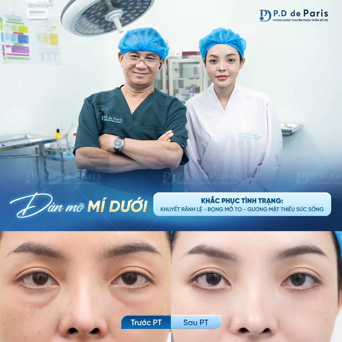 Ai nên thực hiện dàn mỡ mí dưới? Dấu hiệu nhận biết đã đến lúc “trẻ hóa ánh nhìn”