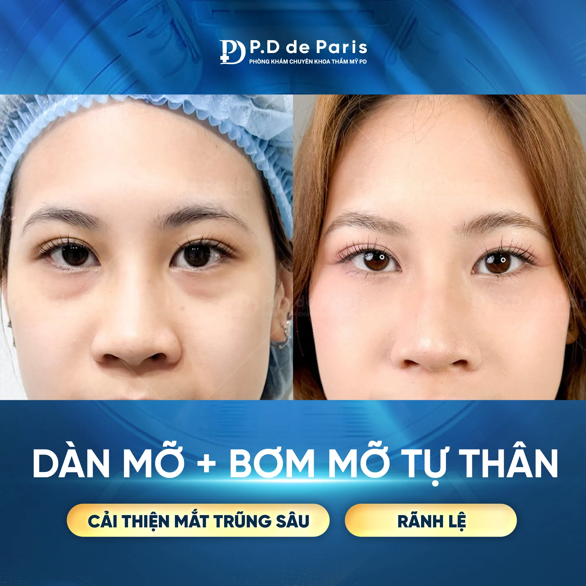 Dàn Mỡ Mí Dưới Có Để Lại Sẹo Không? Bao Lâu Thì Hồi Phục? Chuyên Gia Giải Đáp