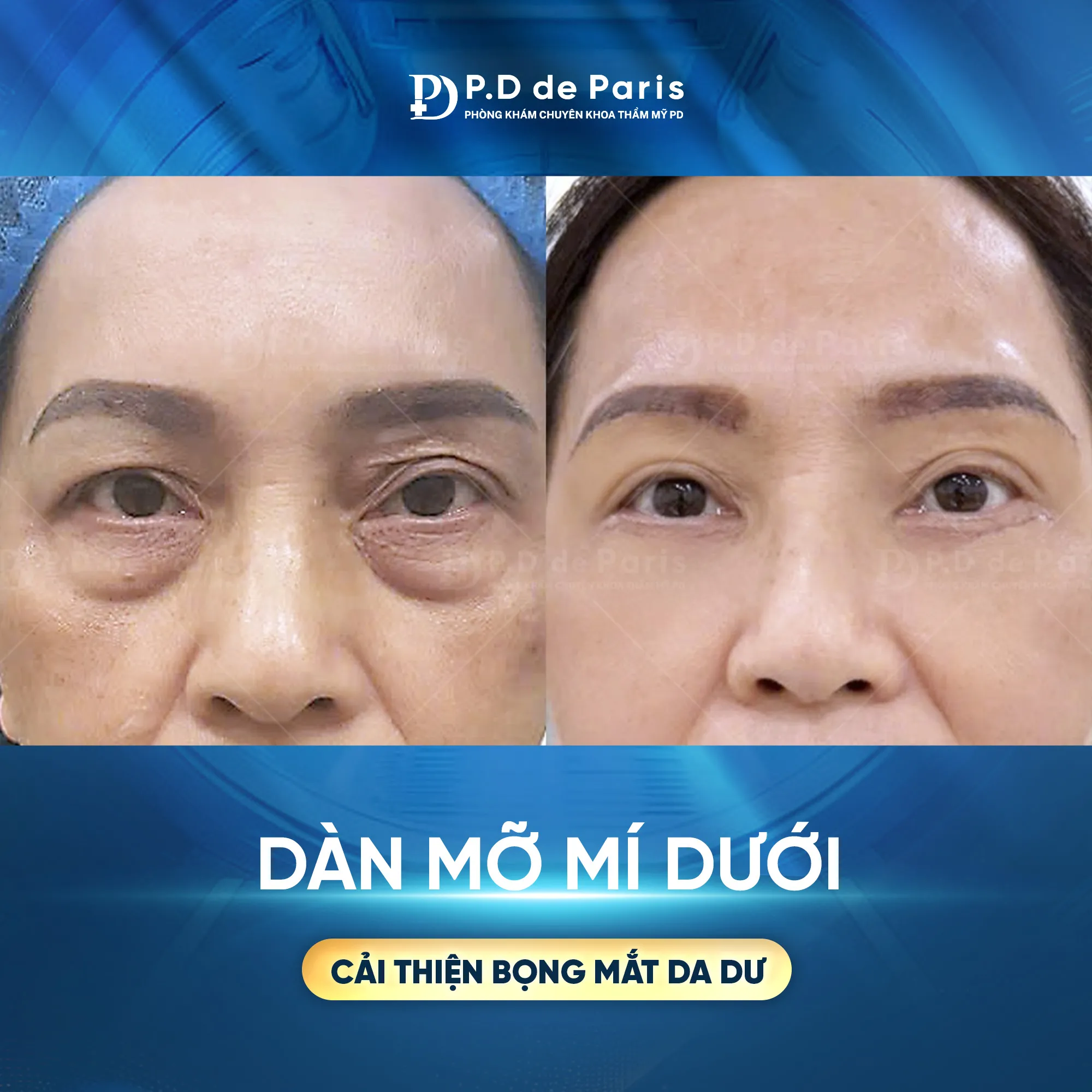Dàn mỡ mí dưới là gì? Quy trình và công nghệ độc quyền tại P.D De Paris