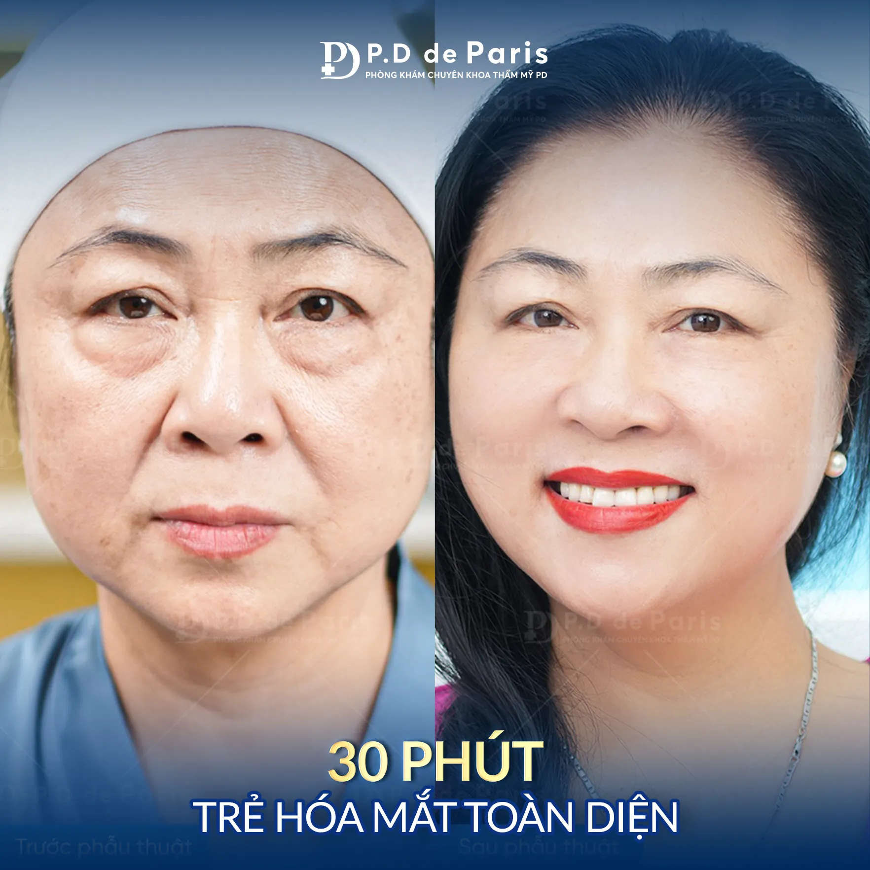 Dàn mỡ mí dưới là gì? Quy trình và công nghệ độc quyền tại P.D De Paris
