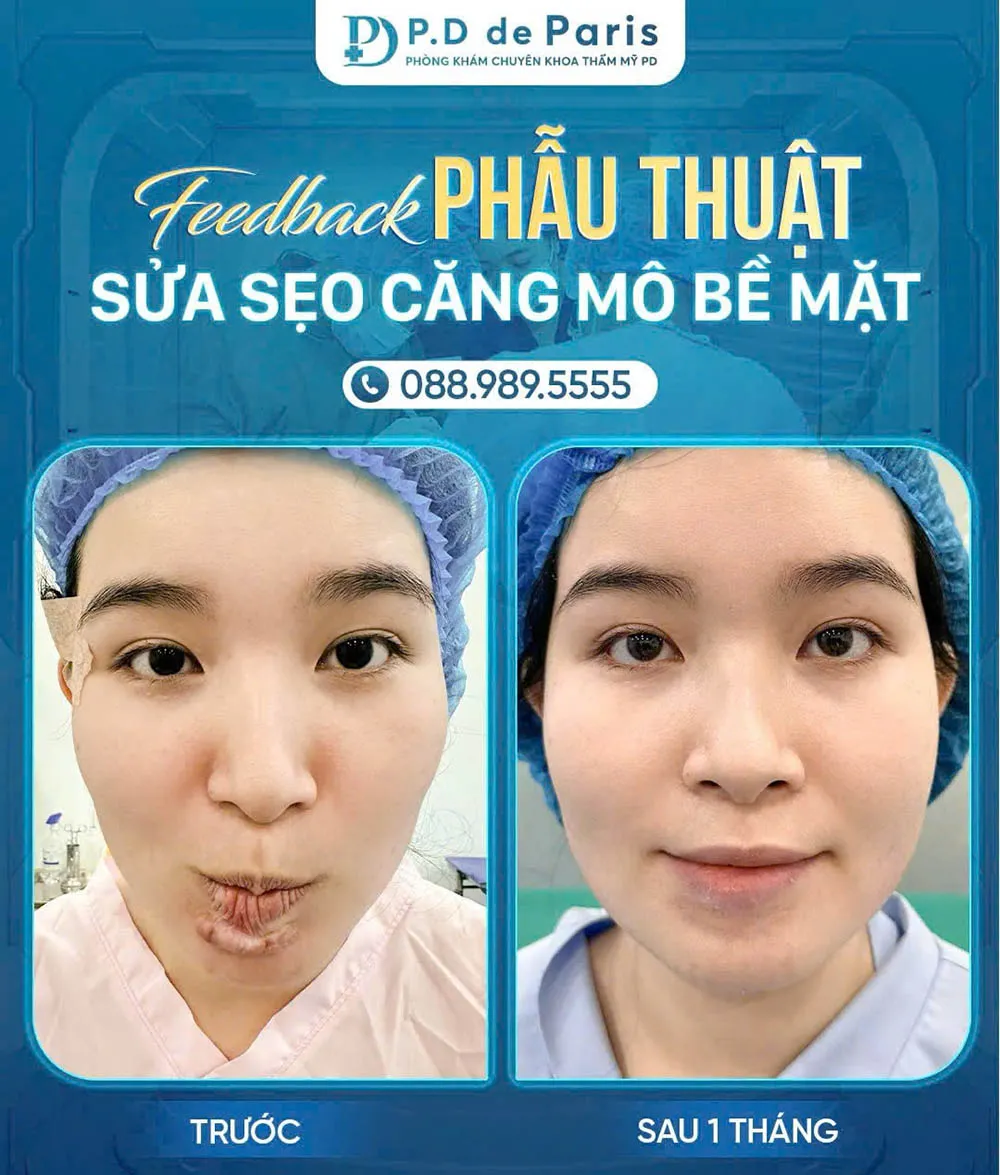 Sửa sẹo căng mô bề mặt: Giải pháp y khoa hiện đại cho làn da sẹo lồi, rỗ, sần sùi tại phòng khám PD de Paris
