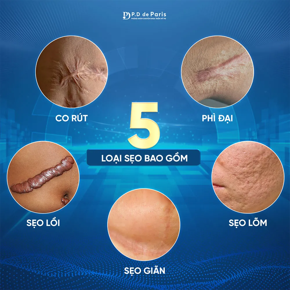 Sửa sẹo căng mô bề mặt: Giải pháp y khoa hiện đại cho làn da sẹo lồi, rỗ, sần sùi tại phòng khám PD de Paris