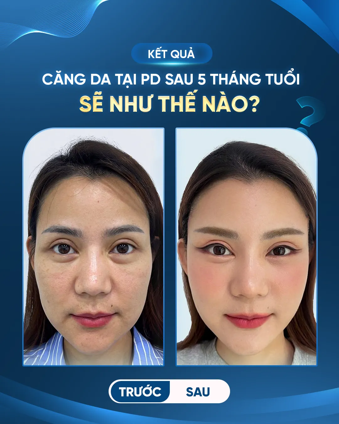Những kỹ thuật căng da mặt định hình 3D triển khai tại Phòng khám PD De Paris?