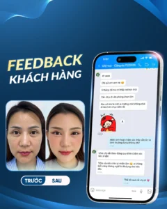 Căng da mặt định hình 3D ở đâu uy tín? Giá bao nhiêu?