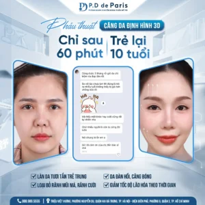 Căng da mặt 3D định hình là gì? Ưu và nhược điểm của phương pháp này