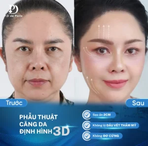 Những kỹ thuật căng da mặt định hình 3D triển khai tại Phòng khám PD De Paris?