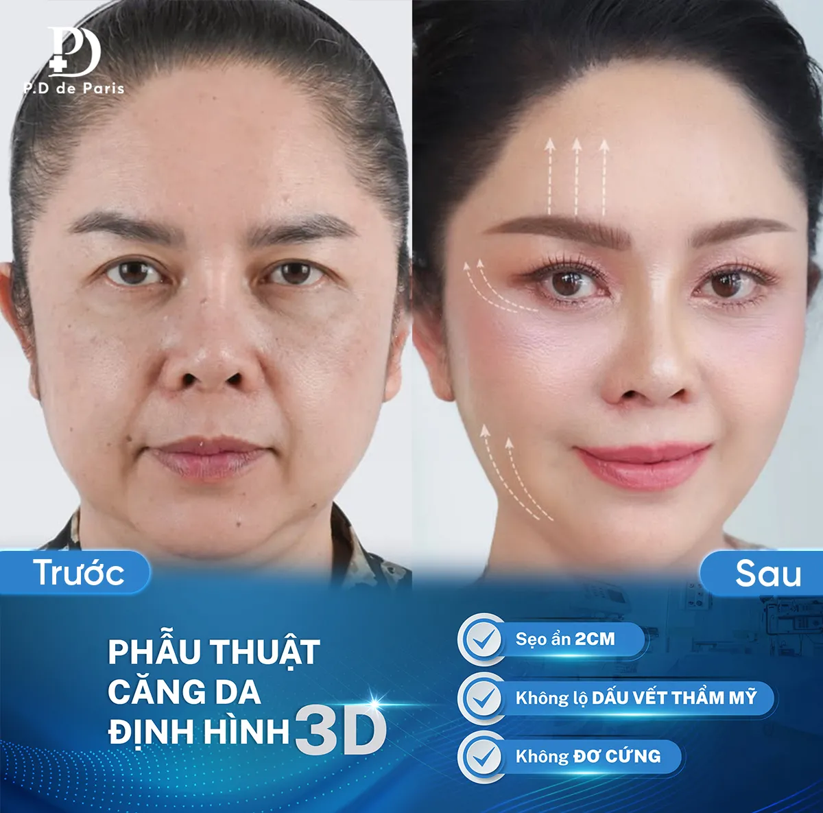 Những kỹ thuật căng da mặt định hình 3D triển khai tại Phòng khám PD De Paris?