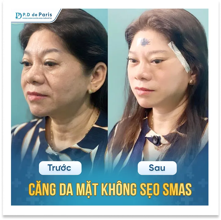 Những kỹ thuật căng da mặt định hình 3D triển khai tại Phòng khám PD De Paris?