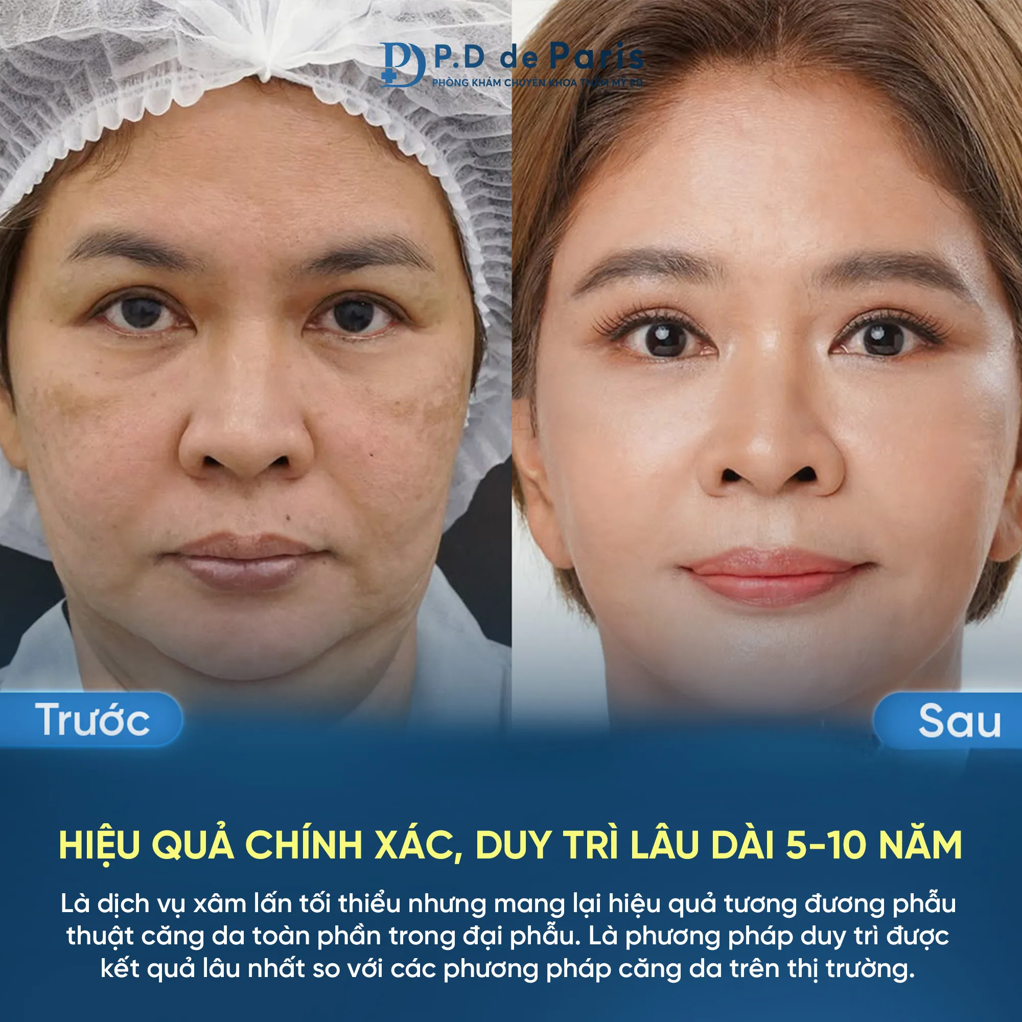 Quy trình căng da mặt định hình 3D tại PD De Paris như thế nào?