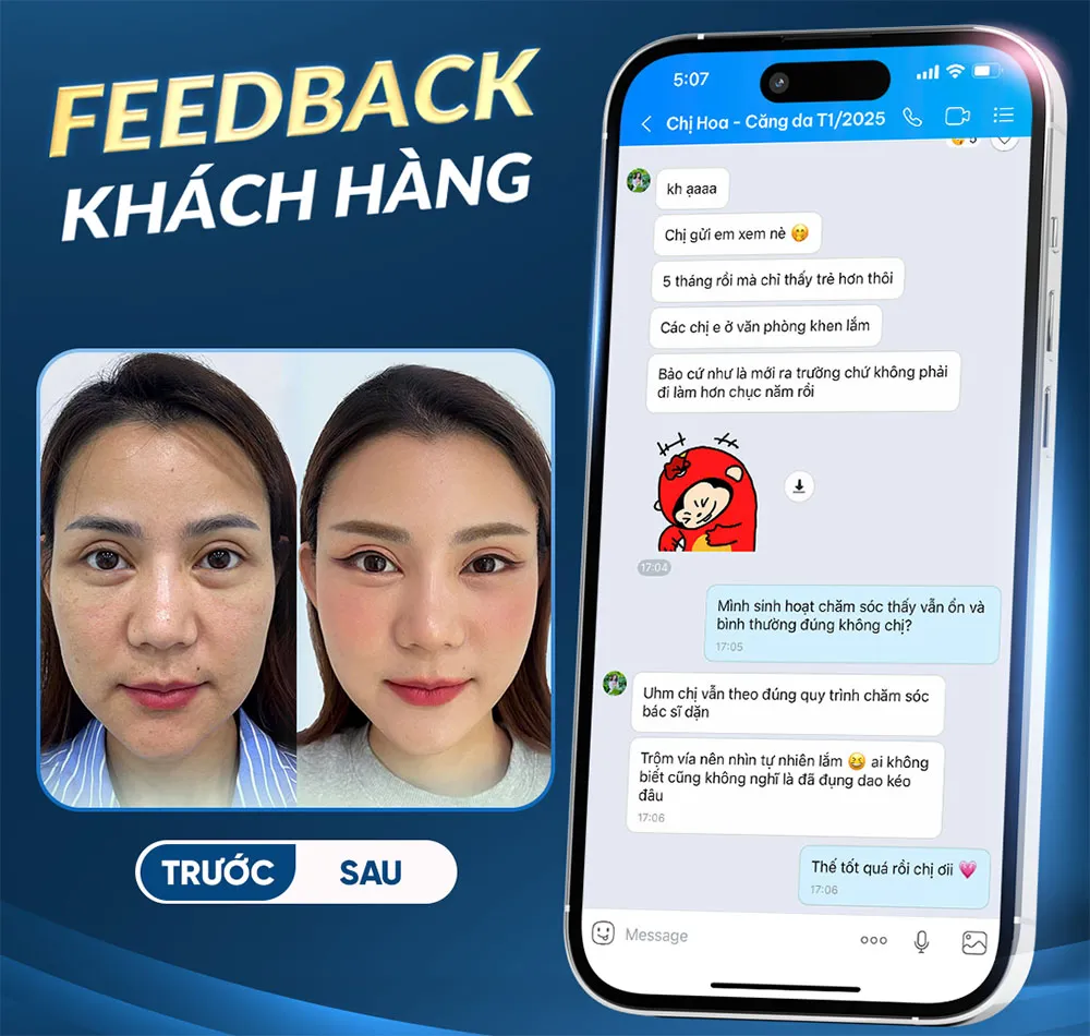 Căng da mặt 3D cần nghỉ dưỡng bao nhiêu ngày?