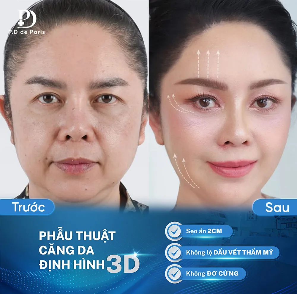 Căng da mặt định hình 3D có an toàn không? Ai phù hợp để thực hiện?