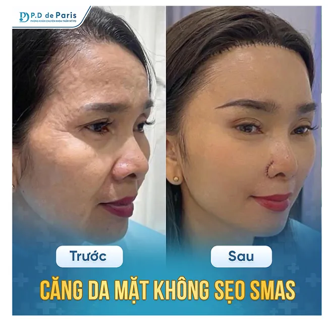 Khi nào thì nên thực hiện căng da mặt định hình 3D, độ tuổi nào là phù hợp nhất?