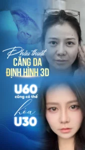 Những ưu điểm vượt trội của kỹ thuật căng da mặt 3D định hình tại PD De Paris ?