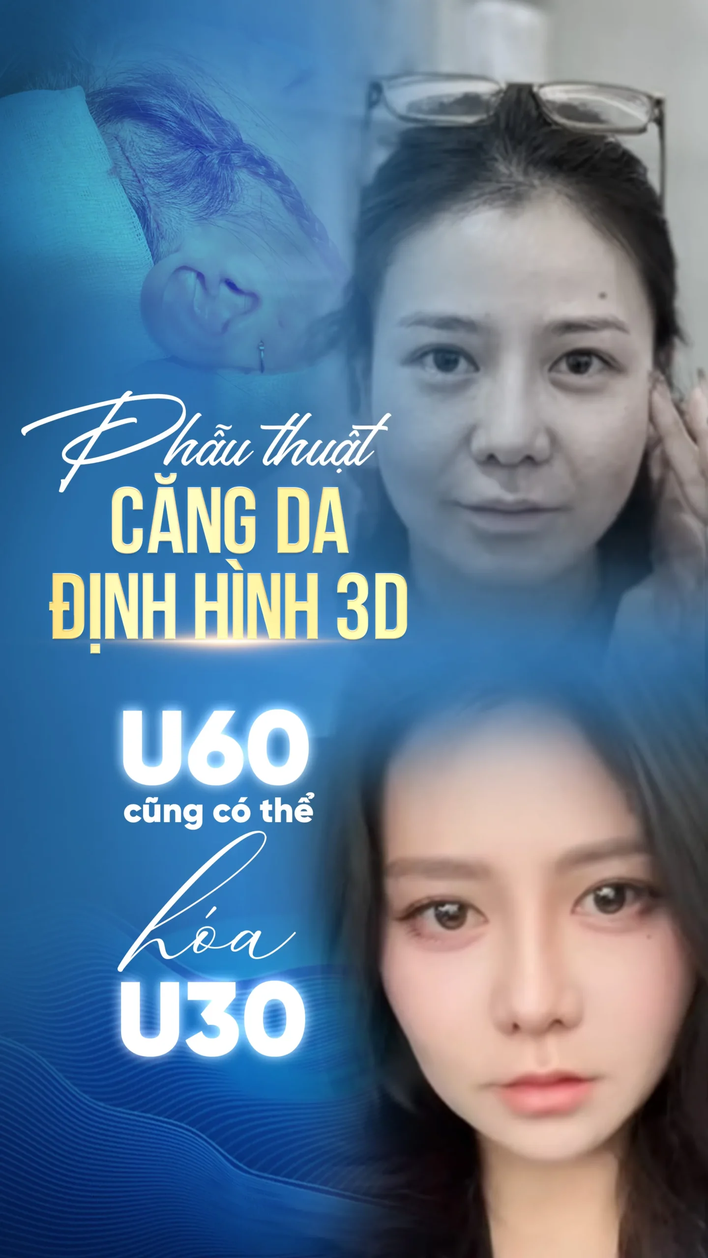 Những ưu điểm vượt trội của kỹ thuật căng da mặt 3D định hình tại PD De Paris ?