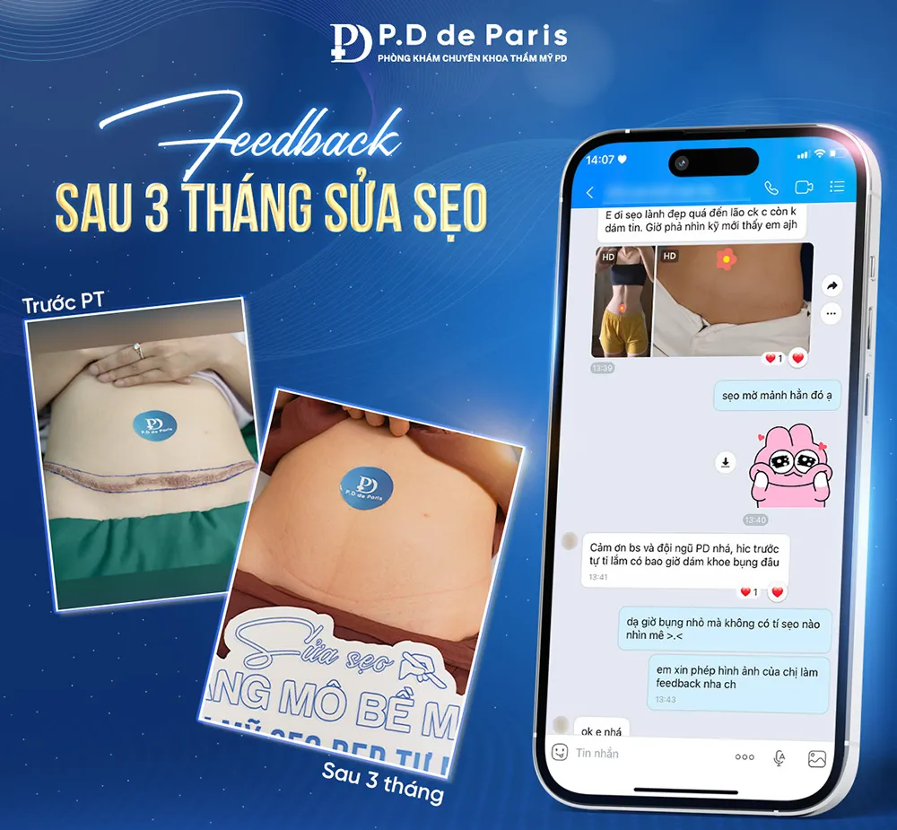 Liệu trình sửa sẹo căng mô bề mặt cần bao nhiêu buổi? Sau bao lâu thấy hiệu quả?