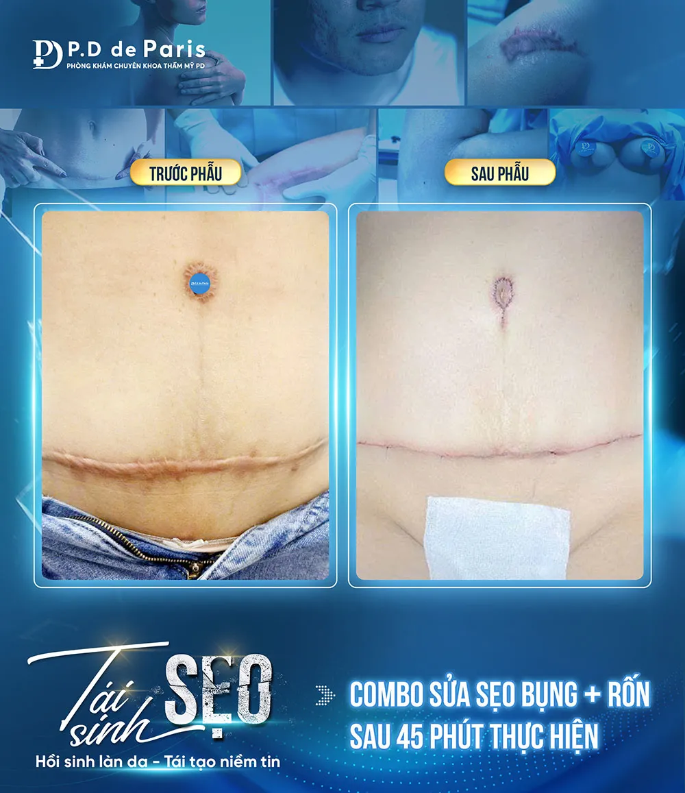 Liệu trình sửa sẹo căng mô bề mặt cần bao nhiêu buổi? Sau bao lâu thấy hiệu quả?