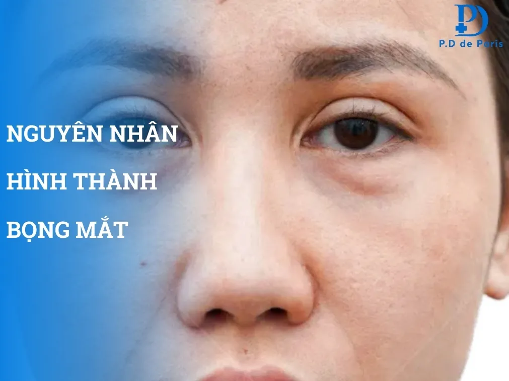 Bọng mắt là gì? Nguyên nhân, dấu hiệu và cách khắc phục hiệu quả