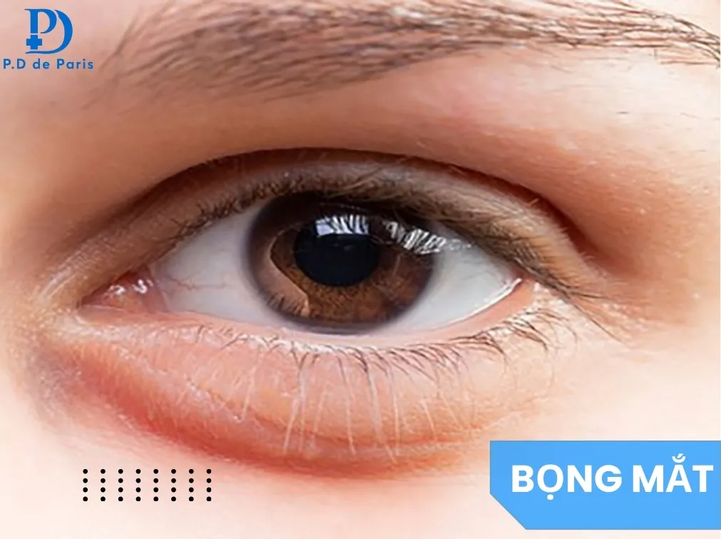 Bọng mắt là gì? Nguyên nhân, dấu hiệu và cách khắc phục hiệu quả