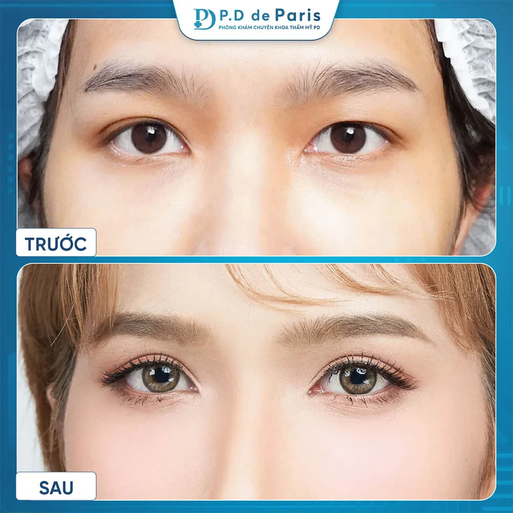 Vì sao hốc mắt sâu? Nguyên nhân và cách khắc phục hiệu quả nhất