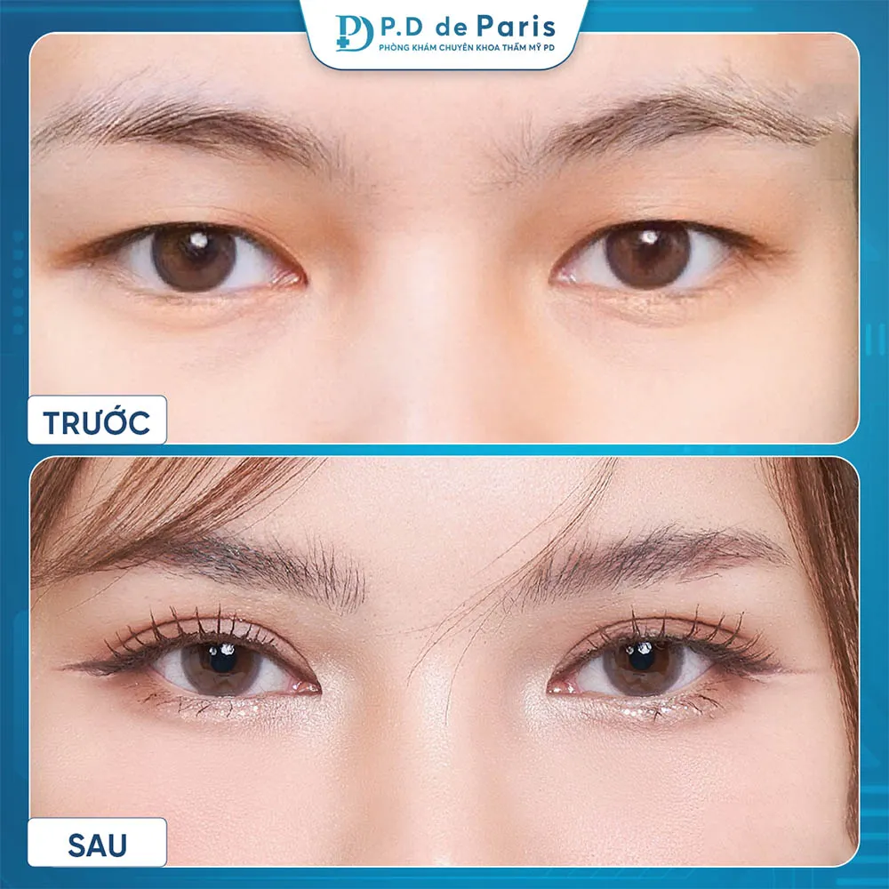 Vì sao hốc mắt sâu? Nguyên nhân và cách khắc phục hiệu quả nhất