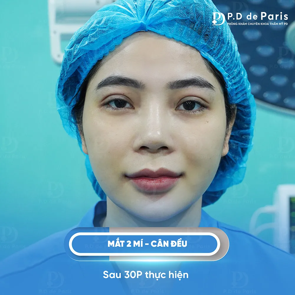 Vì sao hốc mắt sâu? Nguyên nhân và cách khắc phục hiệu quả nhất