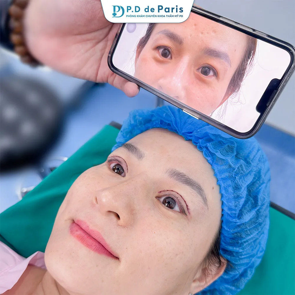 Vì sao hốc mắt sâu? Nguyên nhân và cách khắc phục hiệu quả nhất