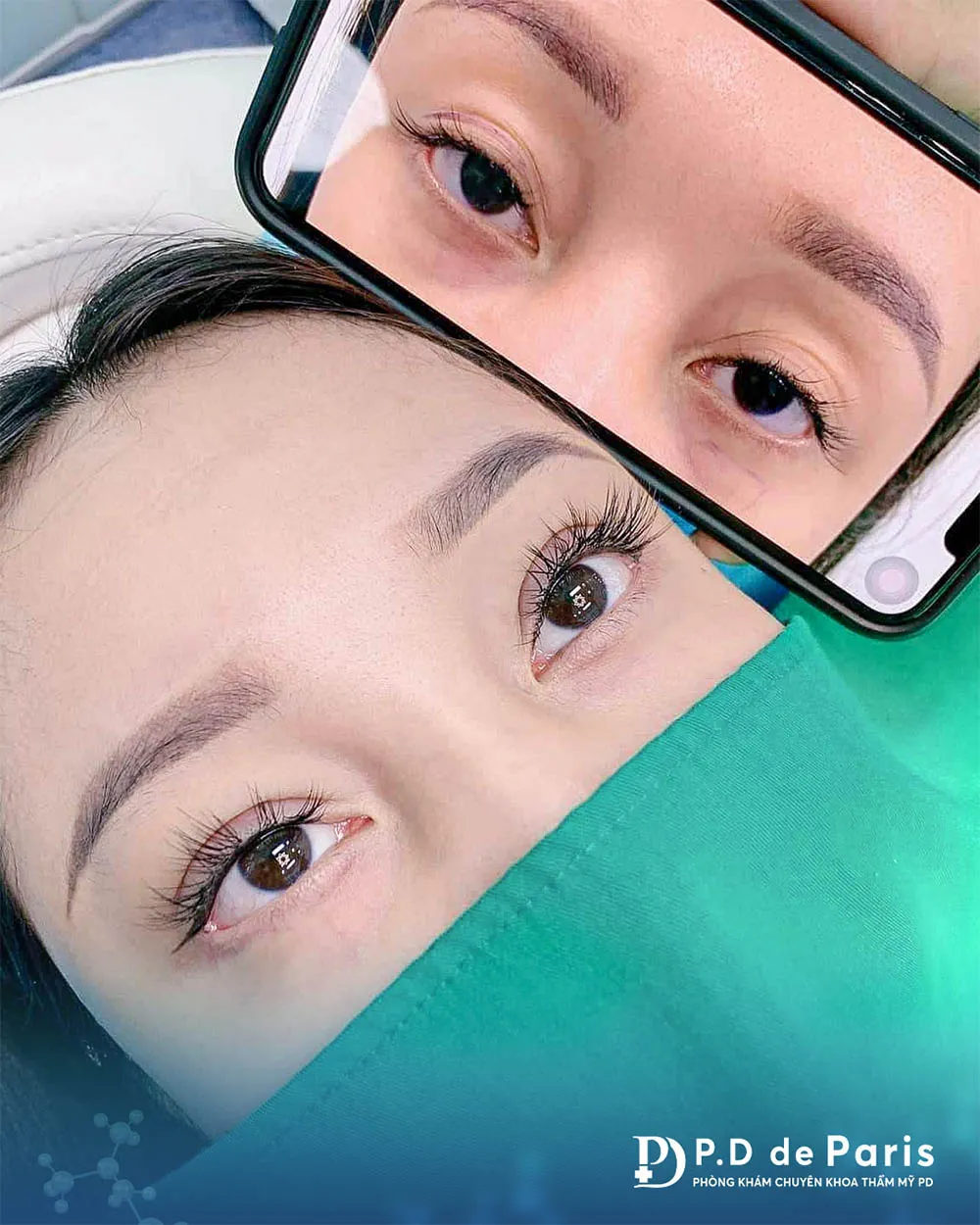 Vì sao hốc mắt sâu? Nguyên nhân và cách khắc phục hiệu quả nhất