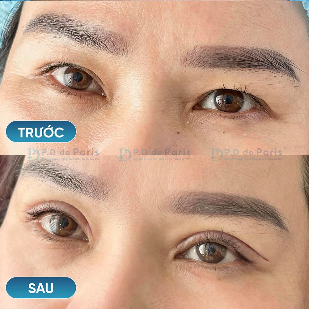 Vì sao hốc mắt sâu? Nguyên nhân và cách khắc phục hiệu quả nhất