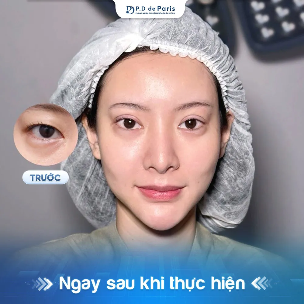 Vì sao hốc mắt sâu? Nguyên nhân và cách khắc phục hiệu quả nhất