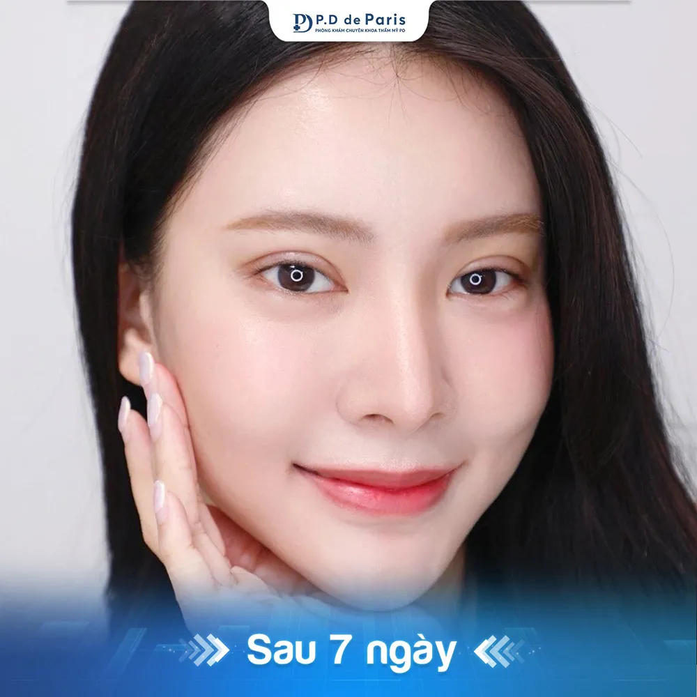 Vì sao hốc mắt sâu? Nguyên nhân và cách khắc phục hiệu quả nhất