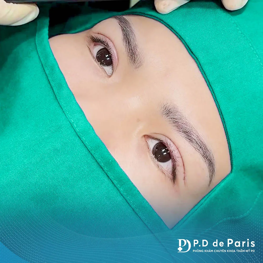 Vì sao hốc mắt sâu? Nguyên nhân và cách khắc phục hiệu quả nhất