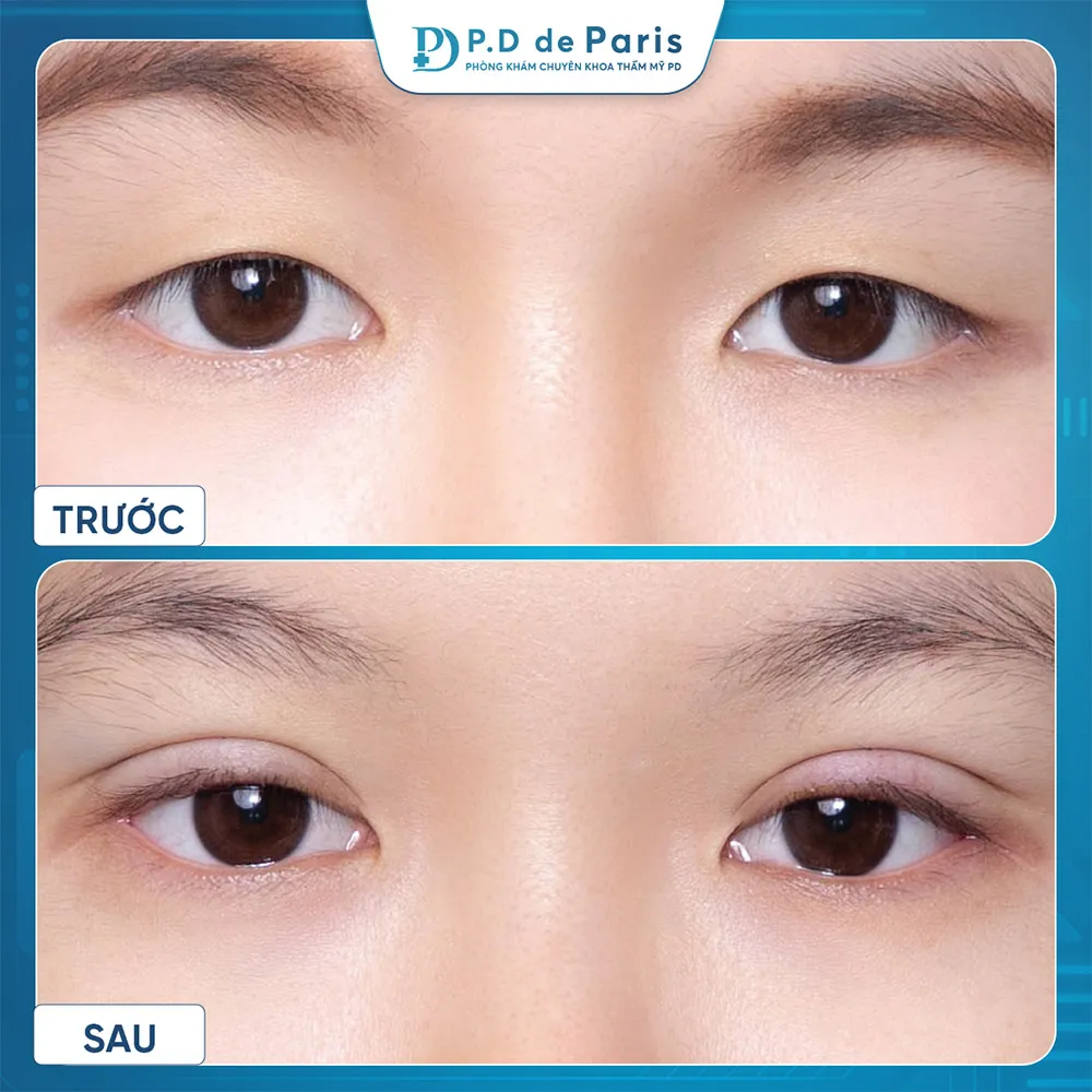 Vì sao hốc mắt sâu? Nguyên nhân và cách khắc phục hiệu quả nhất