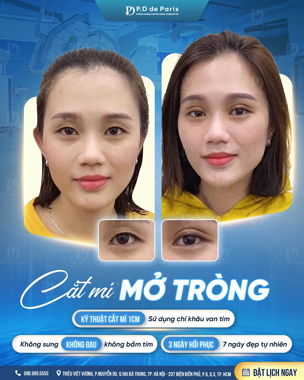 Vì sao hốc mắt sâu? Nguyên nhân và cách khắc phục hiệu quả nhất