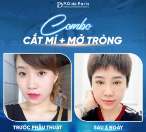 Vì sao hốc mắt sâu? Nguyên nhân và cách khắc phục hiệu quả nhất