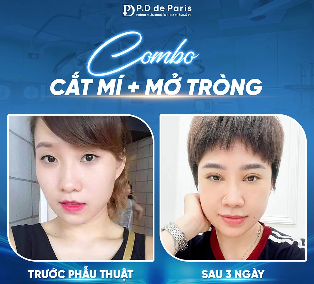 Vì sao hốc mắt sâu? Nguyên nhân và cách khắc phục hiệu quả nhất