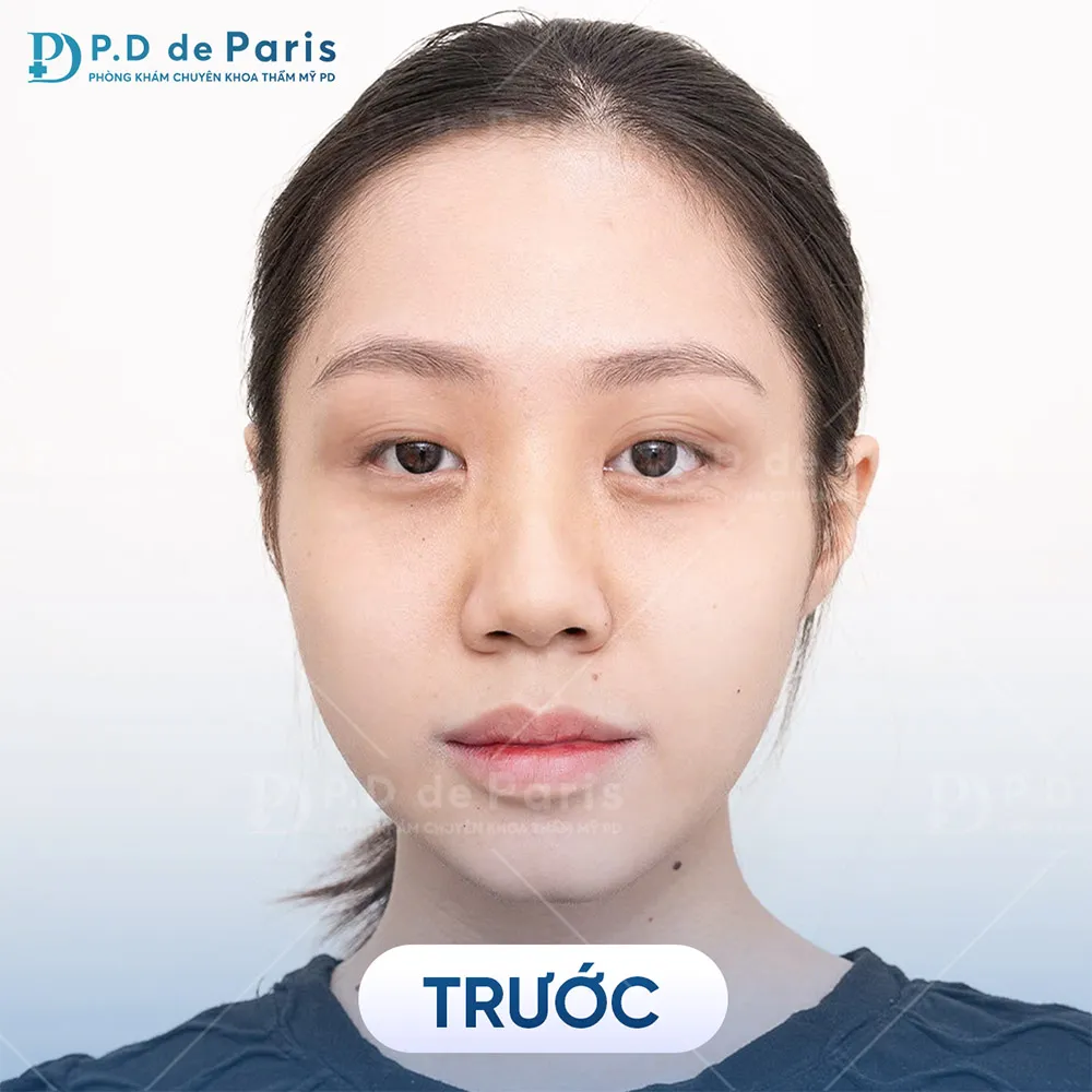 Vì sao hốc mắt sâu? Nguyên nhân và cách khắc phục hiệu quả nhất