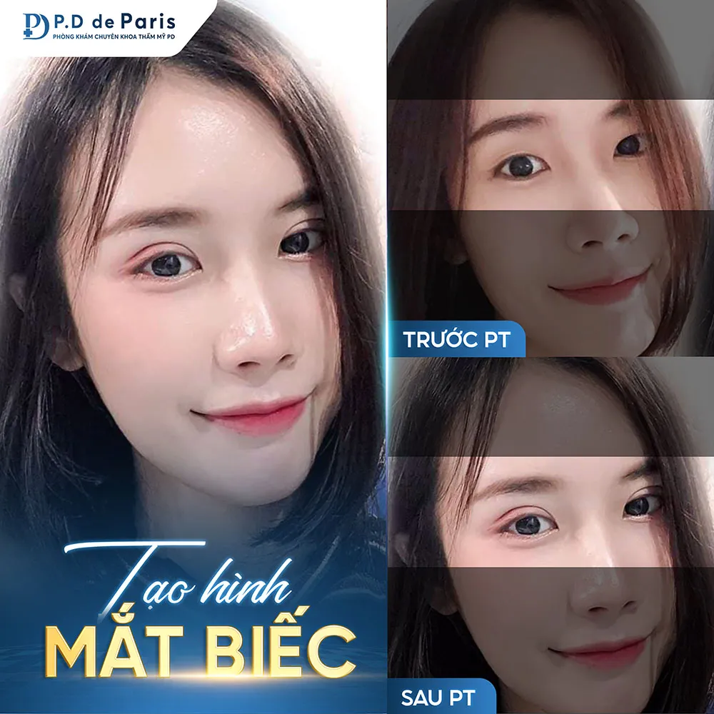 Vì sao hốc mắt sâu? Nguyên nhân và cách khắc phục hiệu quả nhất